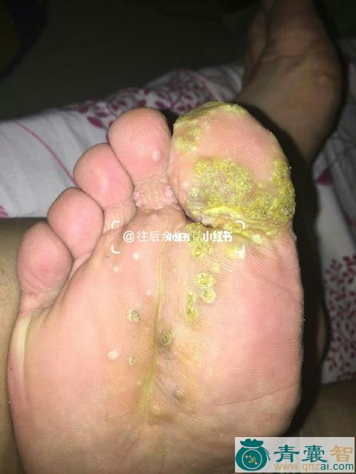 中药材岩脚趾图片