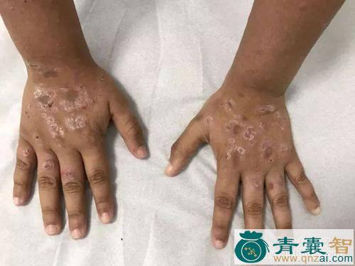 中药材病疳子图片