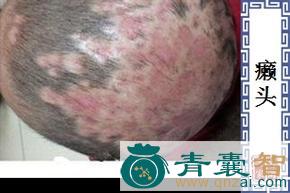 中药材癞痢头图片